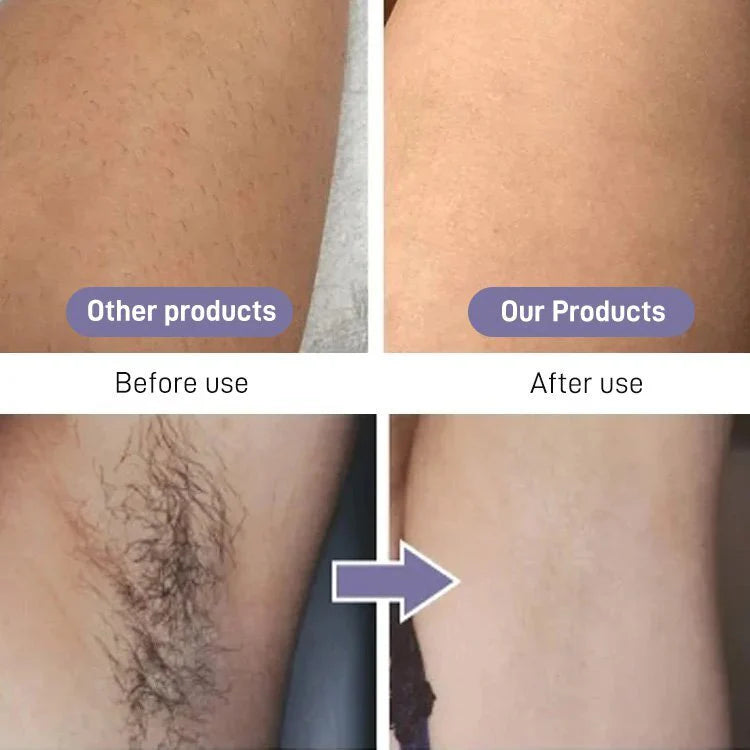 Removeo - Painless Facial & Body Hair Trimmer